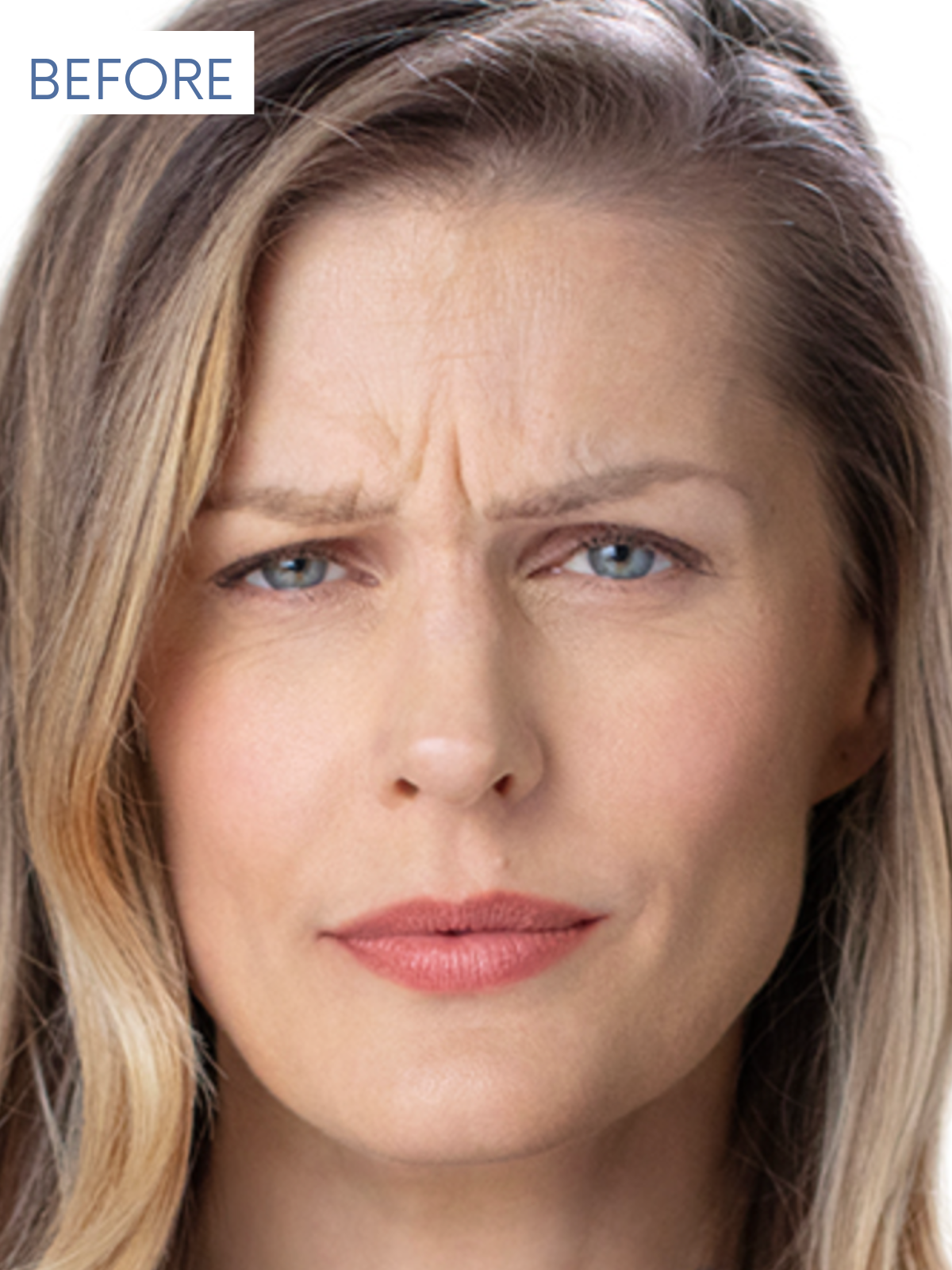 BOTOX BEFORE
