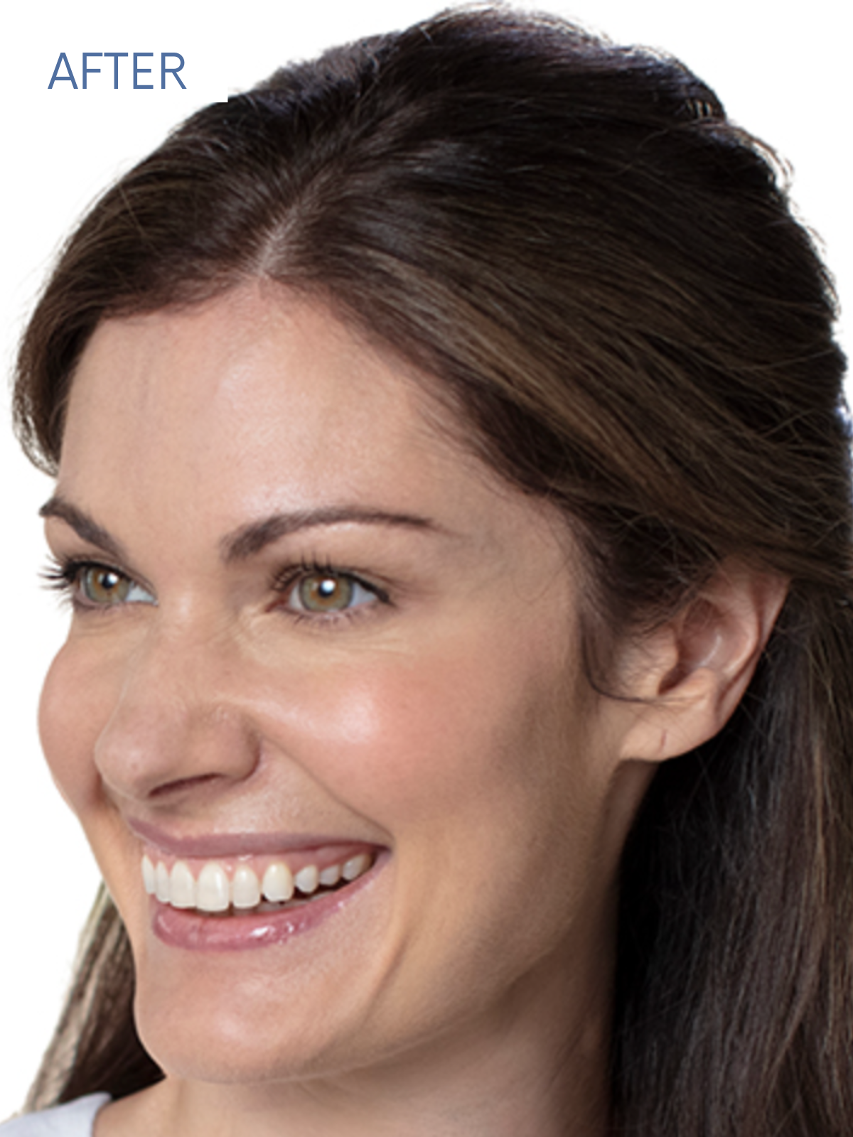 Restylane 2-2 (6)
